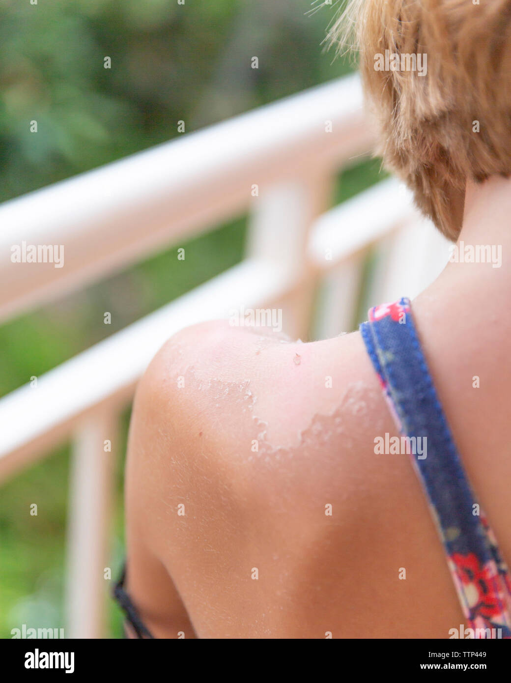 Ansicht der Rückseite des Mädchen mit Sonnenbrand blätterte durch Geländer Stockfoto