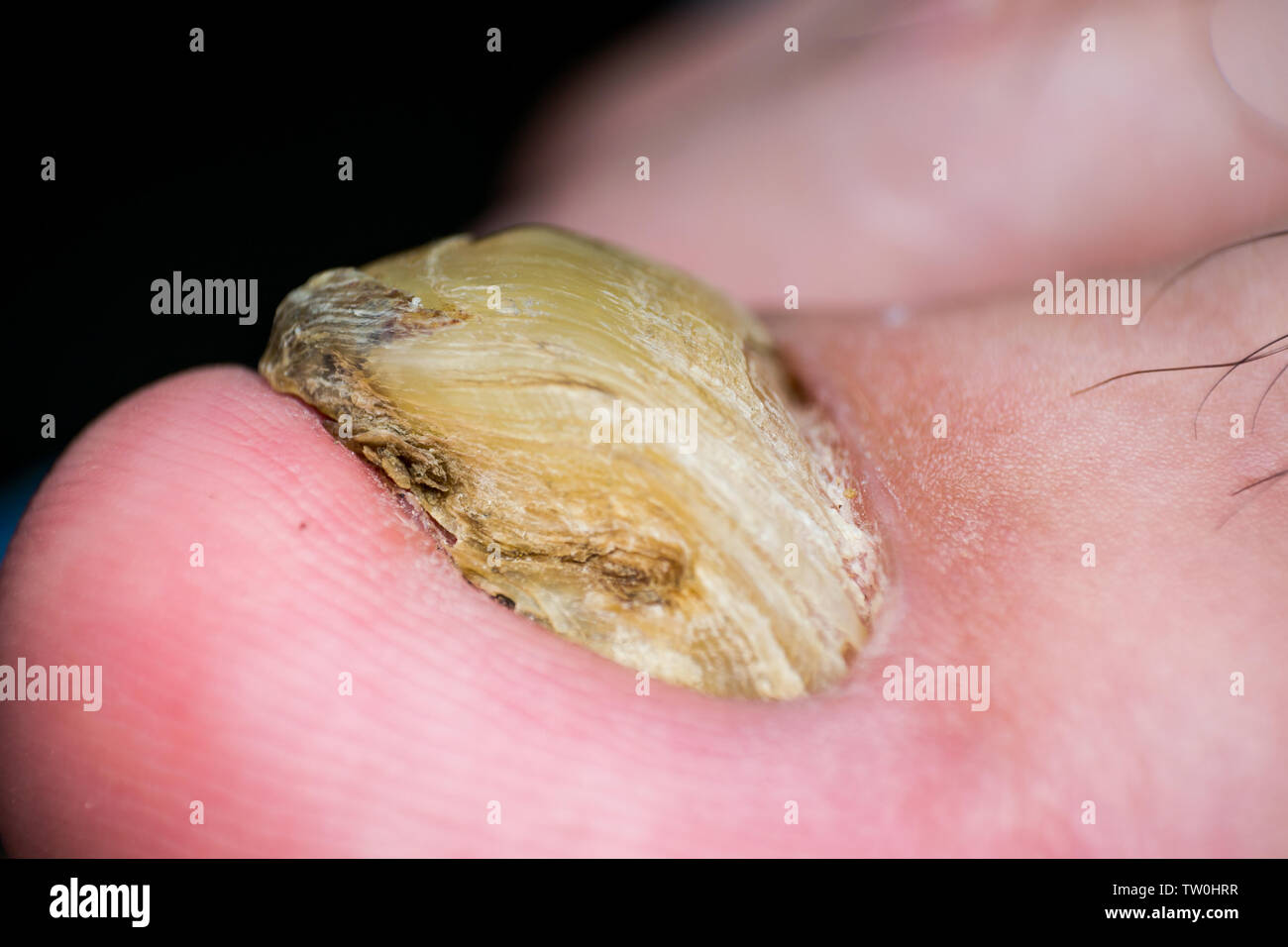 Makro Foto eines menschlichen Zehennagel mit Pilz Stockfoto