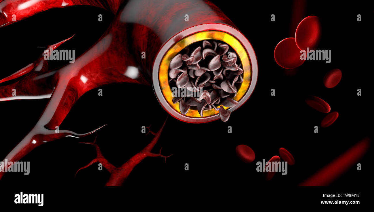 Sichelzellenanämie, Anzeigen Blutgefäß mit Normal- und deformated Crescent. 3D-Darstellung. Stockfoto