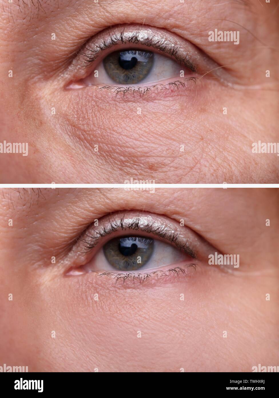 Close-up Woman's Eye Beutel Vor und Nach der kosmetischen Behandlung Stockfoto