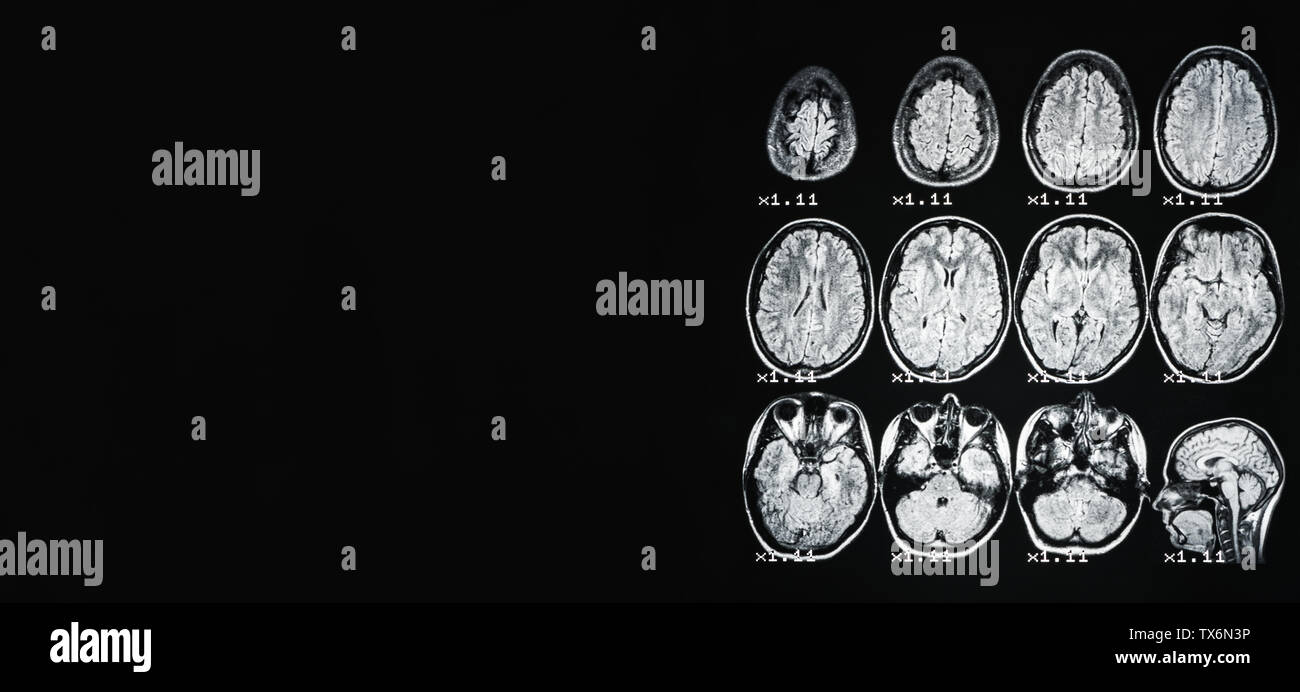 Banner. Mrt des Gehirns einer gesunden Person auf einem schwarzen Hintergrund mit grau Hintergrundbeleuchtung. Auf der linken Seite unter der Beschriftung. Stockfoto