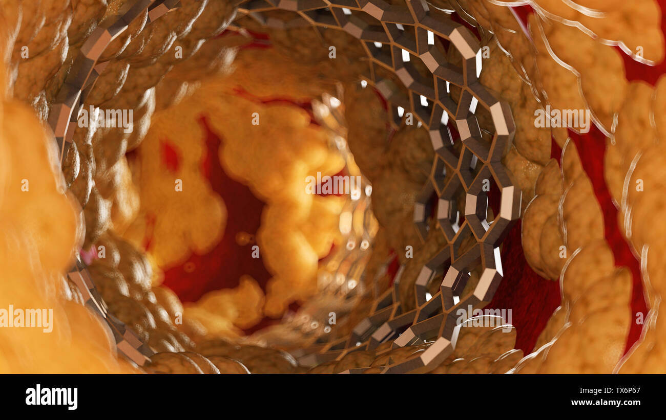 3D-gerenderte Medizinisch genaue Abbildung eines Stents in einem Fettsäuren Arterie Stockfoto