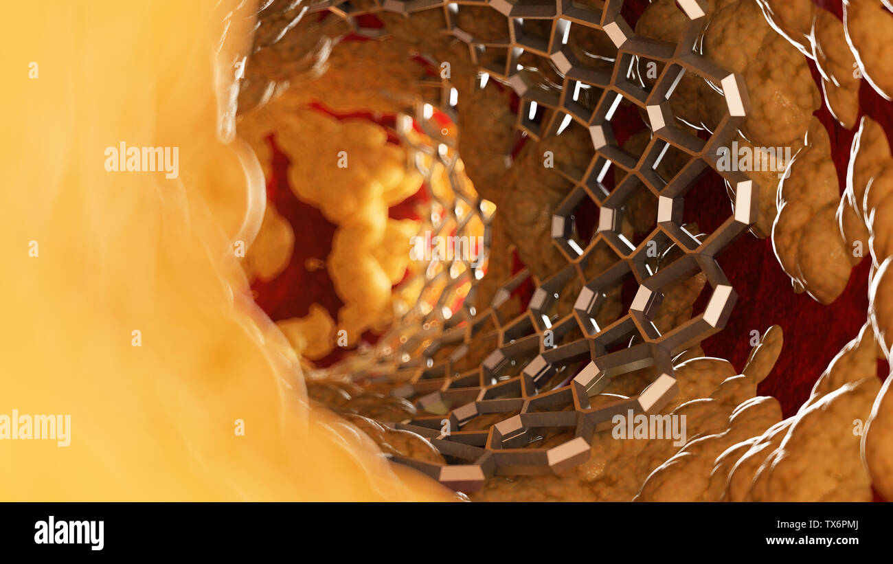 3D-gerenderte Medizinisch genaue Abbildung eines Stents in einem Fettsäuren Arterie Stockfoto