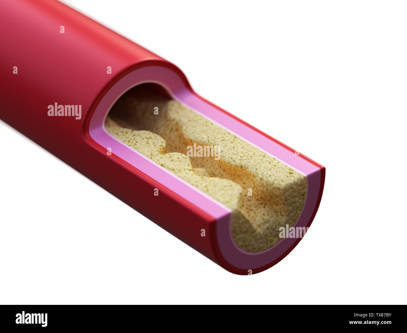 3D-gerenderte Abbildung: eine blockierte Arterie Stockfoto