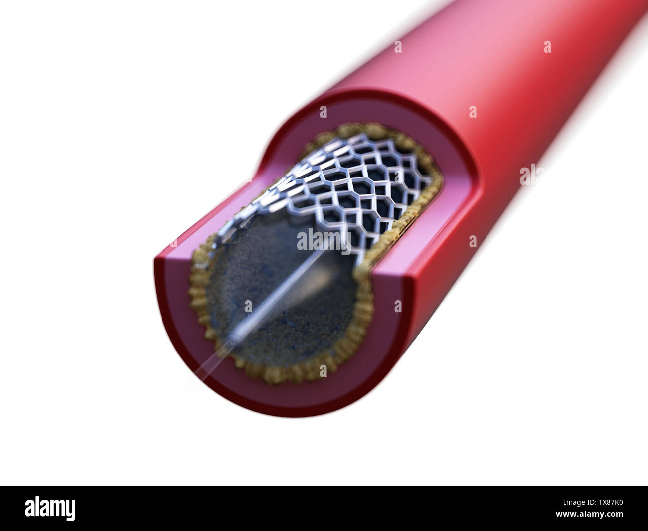 3D-gerenderte Medizinisch genaue Abbildung der Stent in einer Arterie platziert Stockfoto