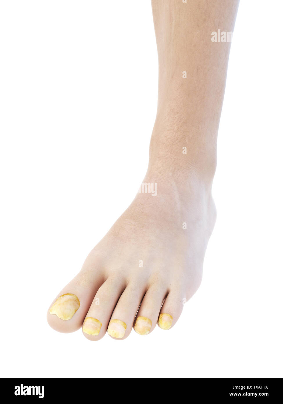 3D gerendert, medizinisch genauen Abbildung des Zehenagelpilzes Stockfoto