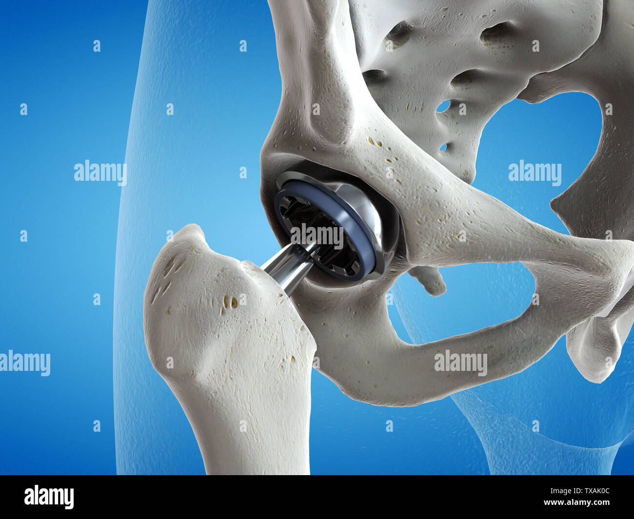 3D-gerenderte Medizinisch genaue Abbildung einer Hüftoperation Stockfoto
