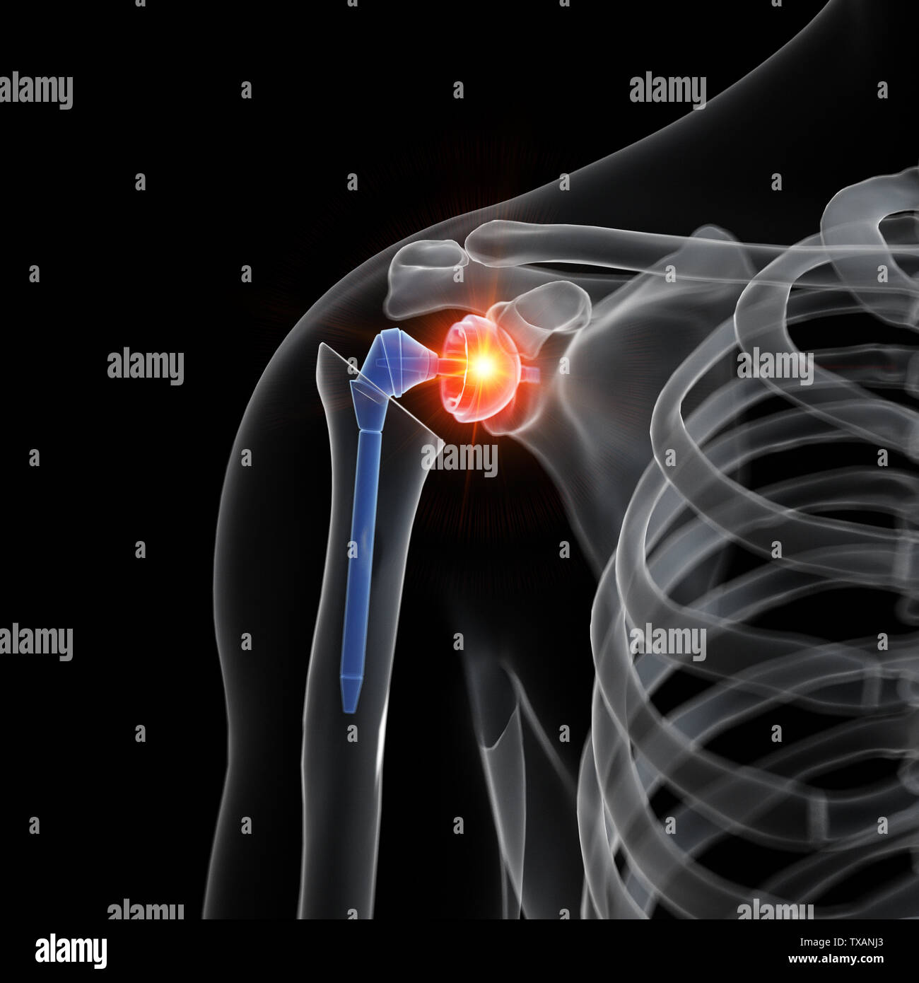 3D-gerenderte Medizinisch genaue Abbildung eines Schulter Austausch Stockfoto