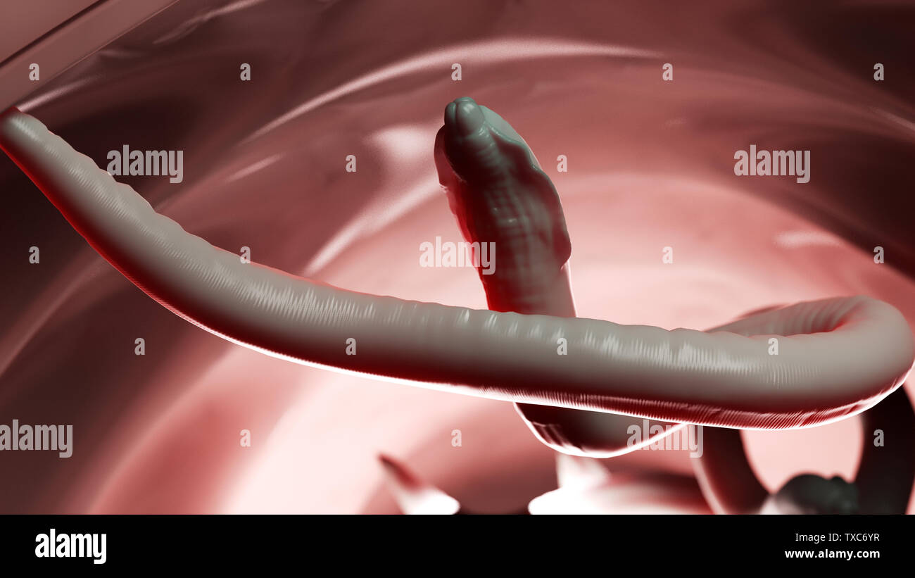 3D-Darstellung eines Rundwürmer im menschlichen Darm Stockfoto