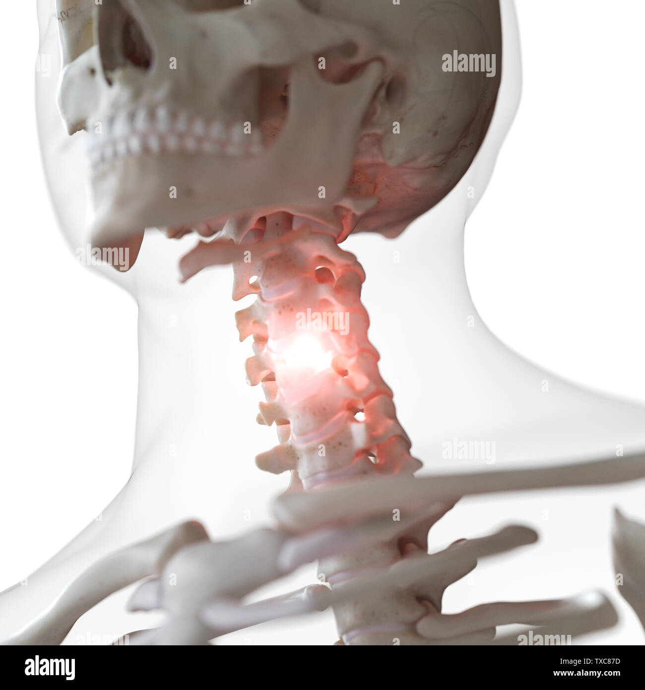 3D-gerenderte Medizinisch genaue Abbildung eines schmerzhaften Halswirbelsäule Stockfoto
