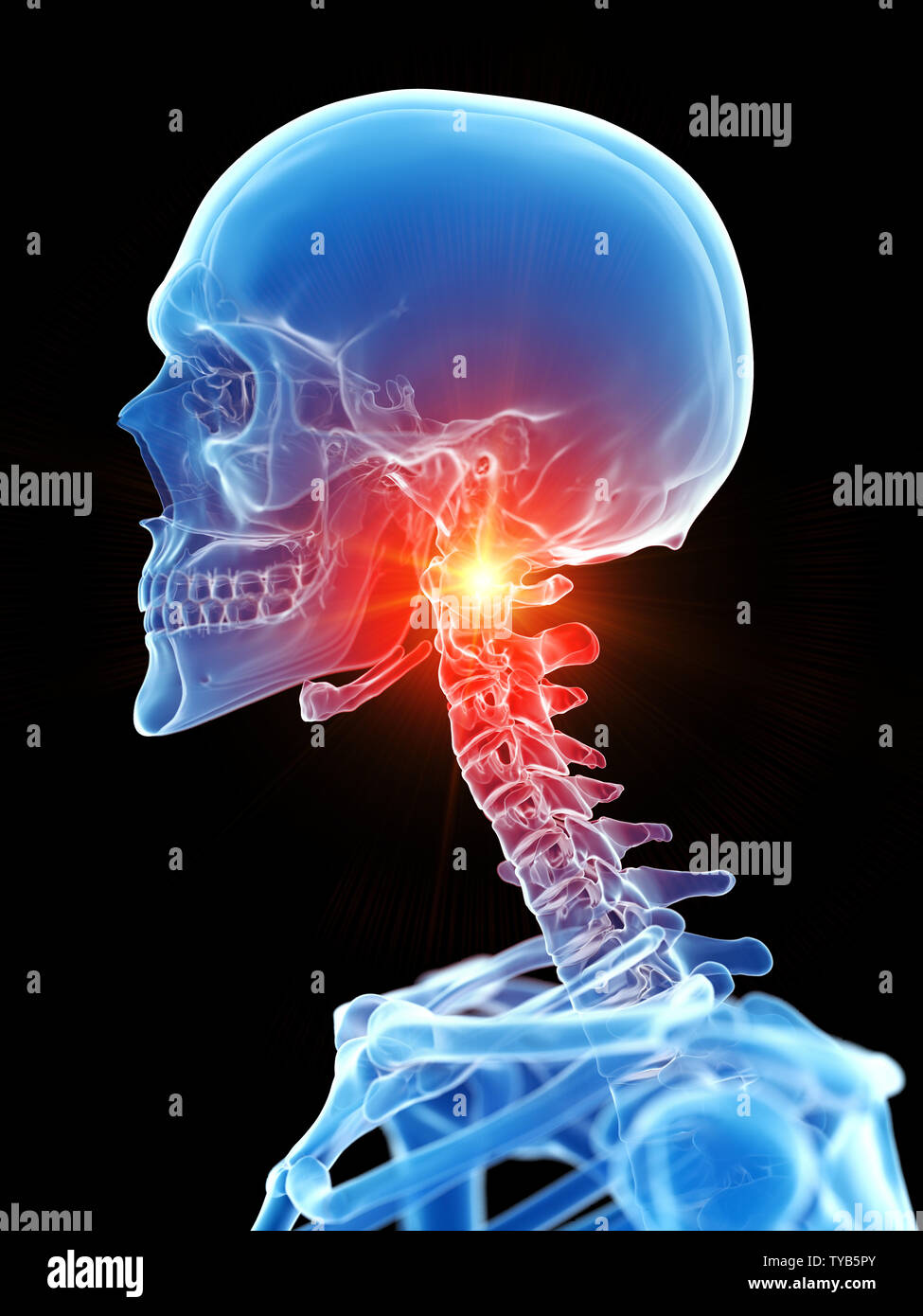 3D-gerenderte Medizinisch genaue Abbildung der Halswirbelsäule, Schmerzen Stockfoto