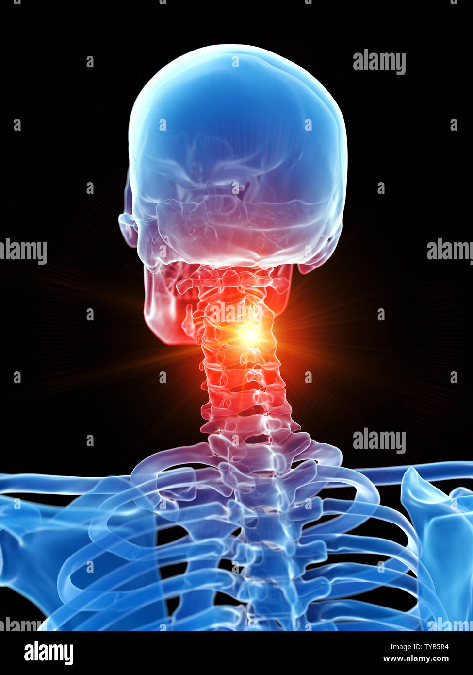 3D-gerenderte Medizinisch genaue Abbildung der Halswirbelsäule, Schmerzen Stockfoto