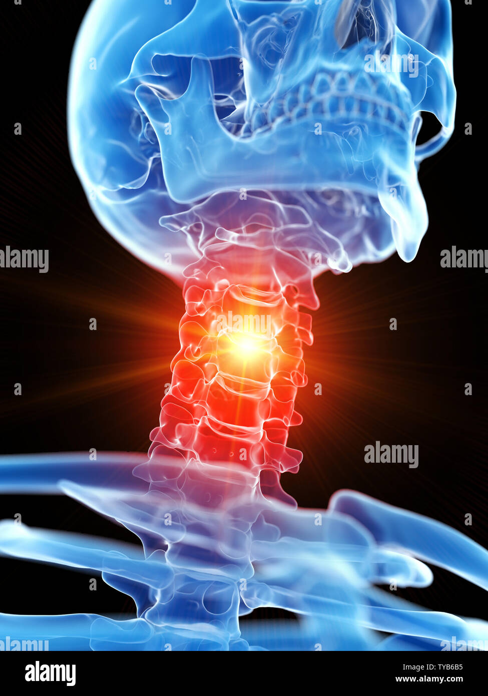 3D-gerenderte medizinisch genauen Abbildung des zervikalen Hals, Schmerzen Stockfoto