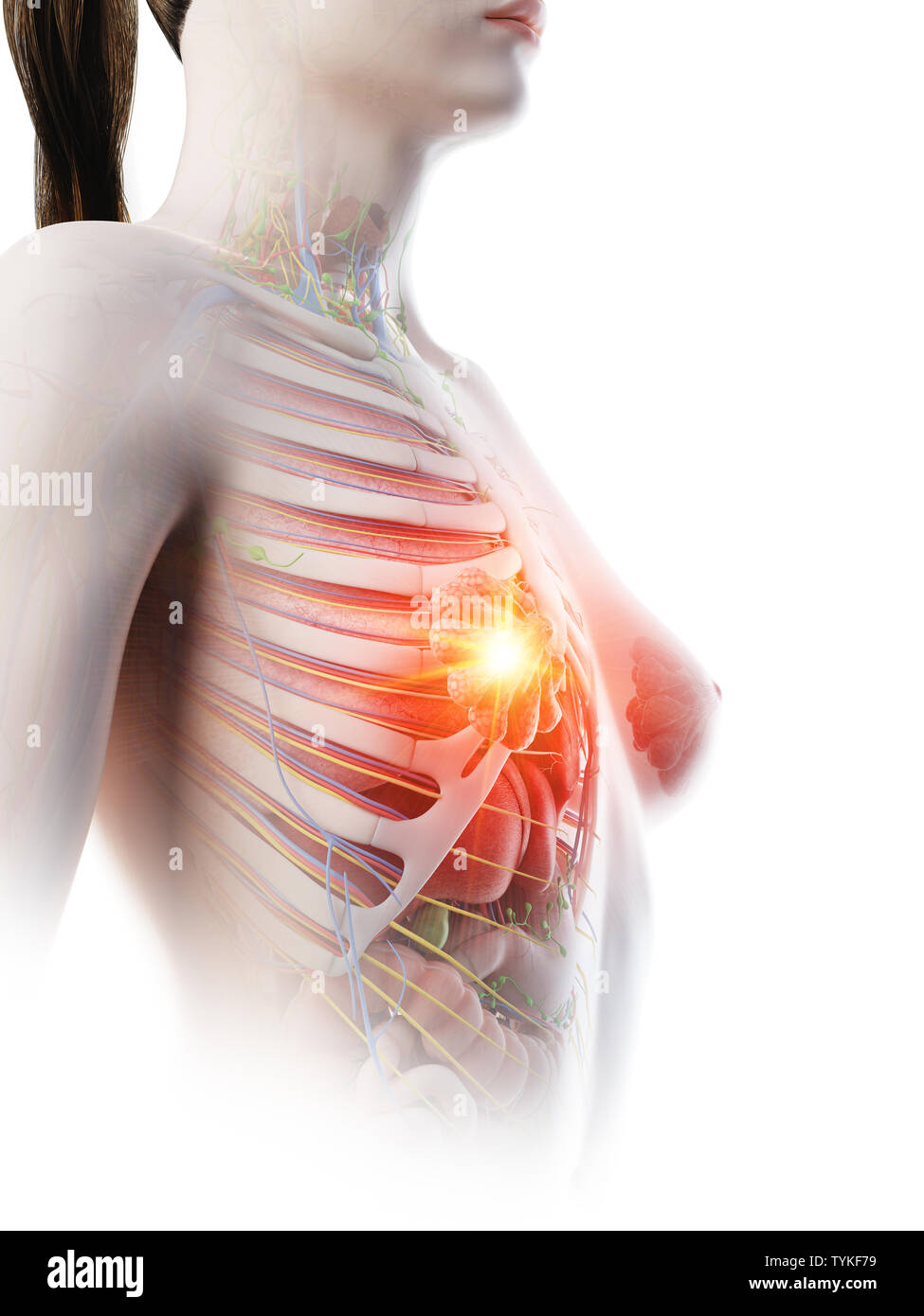 3D-Darstellung eines Weibchen entzündeten Brustdrüsen Stockfoto