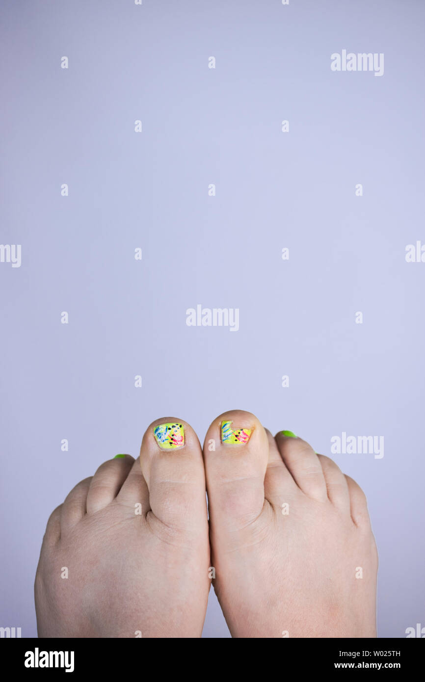 In der Nähe von Broken Toe Nail mit niedlichen gemalt. Obwohl der Zehennagel ist gebrochen die Frauen wird Spaß und positiv. Vertikale, gekreuzt Stockfoto