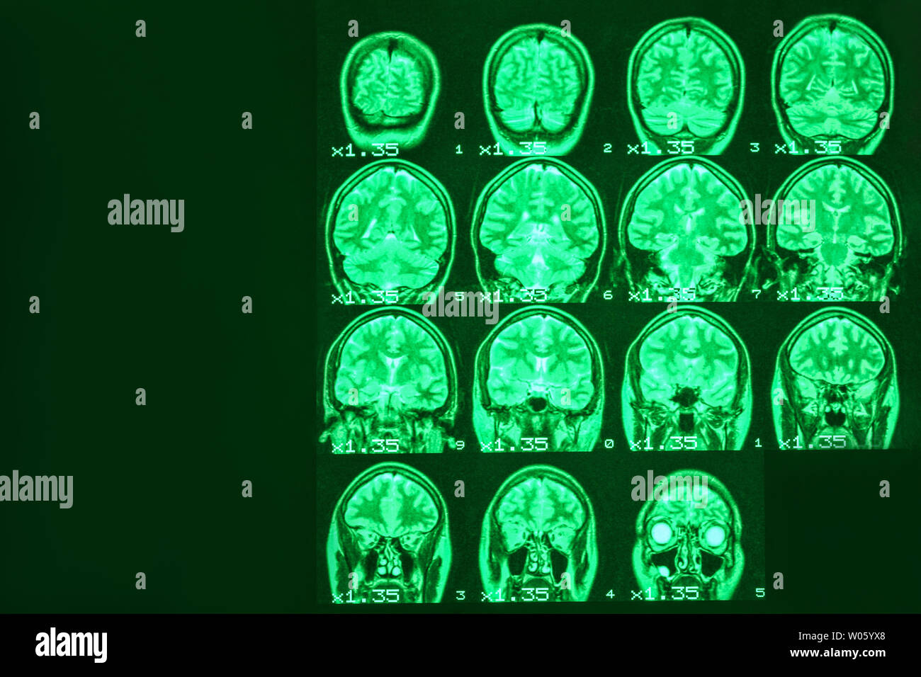 Mrt des Gehirns einer gesunden Person auf einem schwarzen Hintergrund mit grüner Hintergrundbeleuchtung. Links Platz für Werbung Beschriftung Stockfoto
