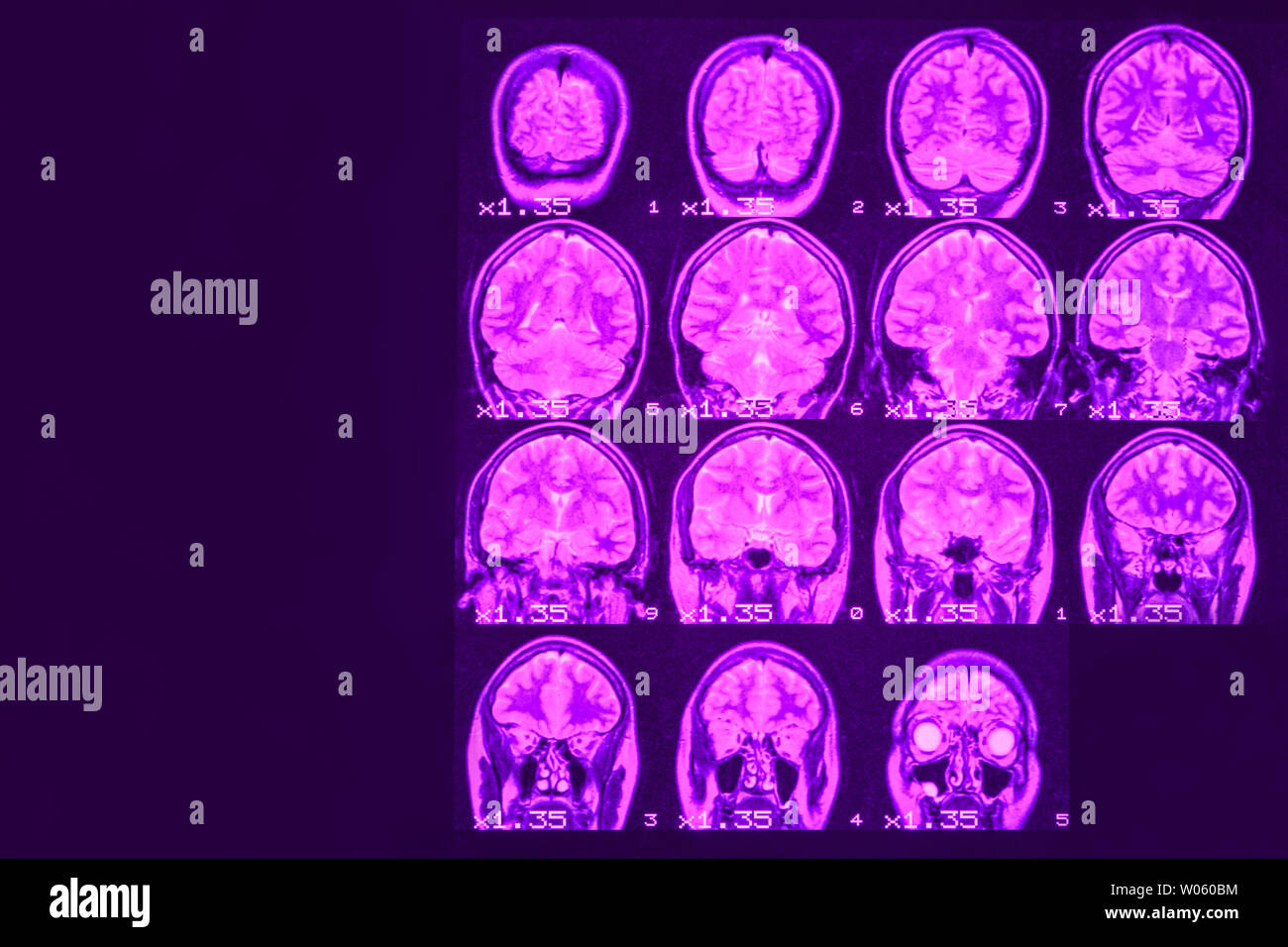 Mrt des Gehirns auf einem schwarzen Hintergrund mit lila Hintergrundbeleuchtung. Links Platz für Werbung Beschriftung Stockfoto
