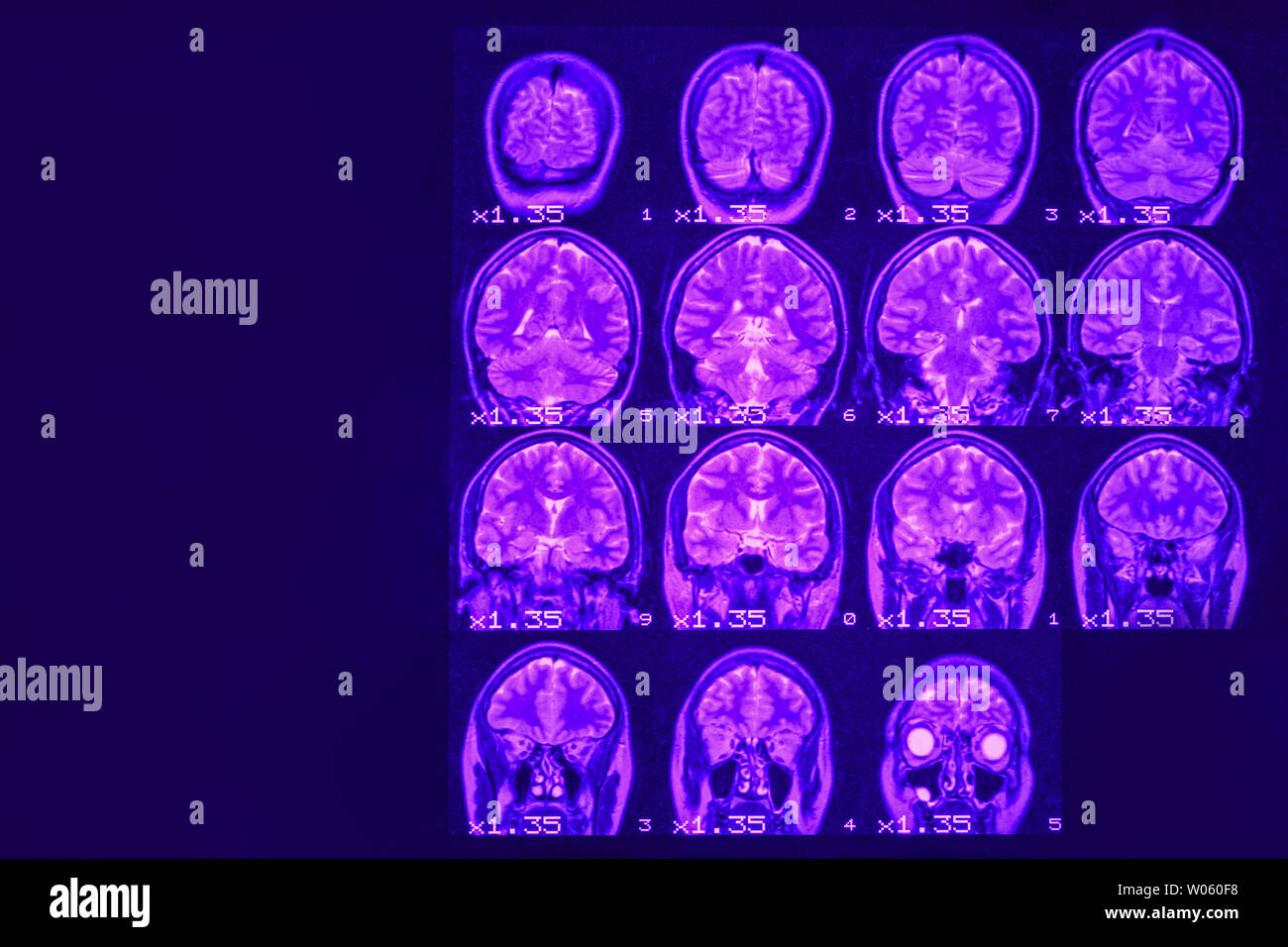 Mrt des Gehirns auf einem schwarzen Hintergrund mit lila Hintergrundbeleuchtung. Links Platz für Werbung Beschriftung Stockfoto