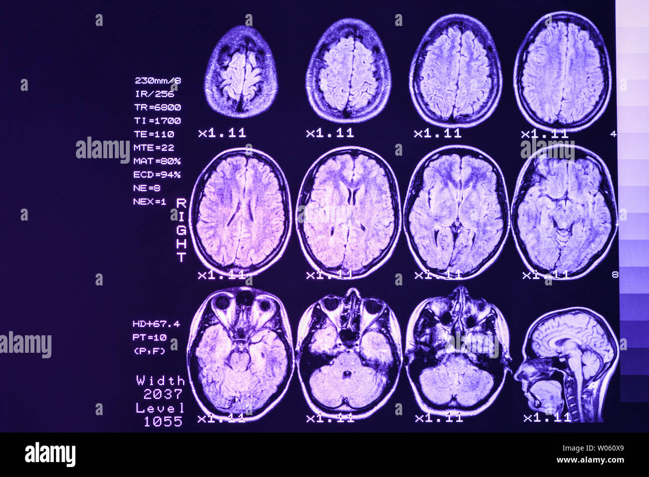 Mrt-Scan oder Magnetic Resonance Image von Kopf und Gehirn scannen. Das Ergebnis ist eine MRT des Gehirns mit Werte und Zahlen mit lila Hintergrundbeleuchtung. Stockfoto