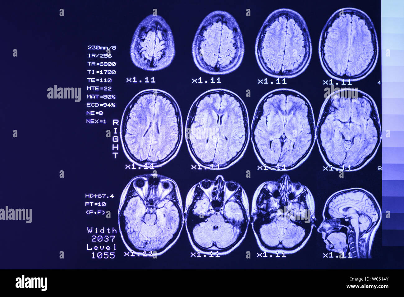 Mrt-Scan oder Magnetic Resonance Image von Kopf und Gehirn scannen. Das Ergebnis ist eine MRT des Gehirns mit Werte und Zahlen mit lila Hintergrundbeleuchtung. Stockfoto