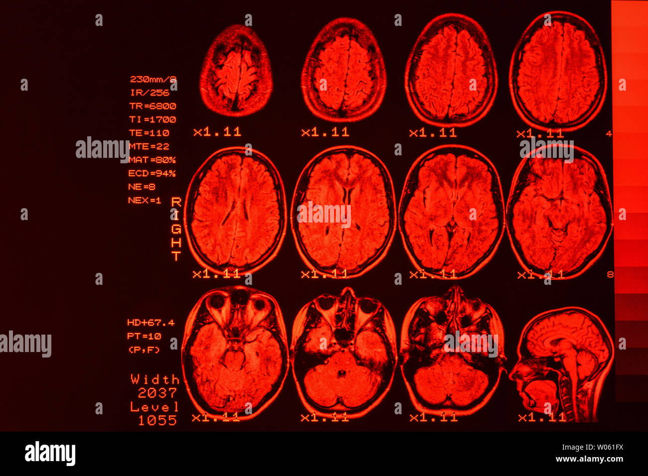 Mrt-Scan oder Magnetic Resonance Image von Kopf und Gehirn scannen. Das Ergebnis ist eine MRT des Gehirns mit Werte und Zahlen mit roter Hintergrundbeleuchtung. Stockfoto