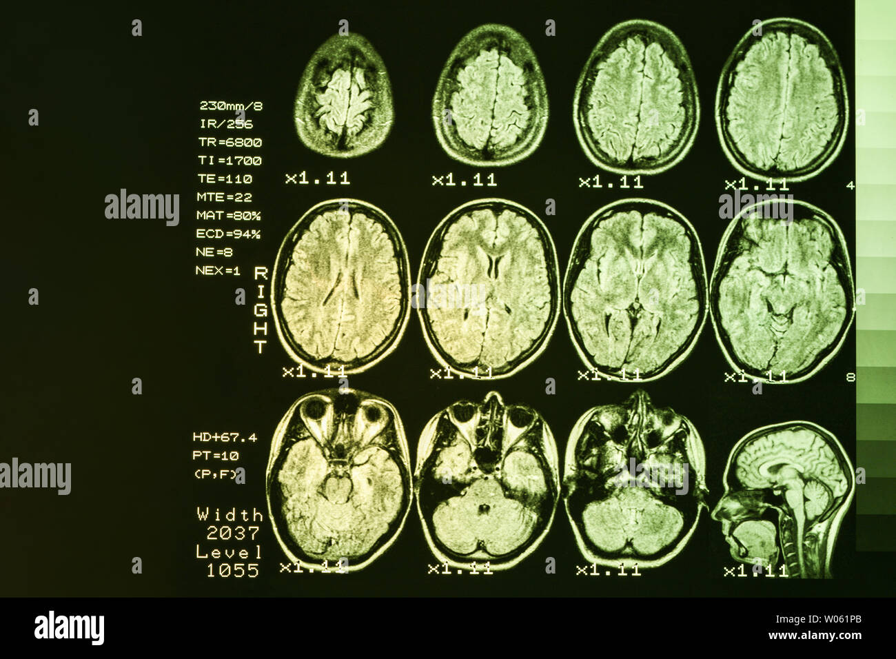 Mrt-Scan oder Magnetic Resonance Image von Kopf und Gehirn scannen. Das Ergebnis ist eine MRT des Gehirns mit Werte und Zahlen mit gelber Hintergrundbeleuchtung. Stockfoto