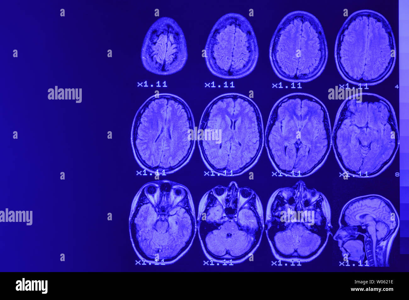 Mrt des Gehirns auf einem schwarzen Hintergrund mit blauer Hintergrundbeleuchtung. Links Platz für Werbung Beschriftung Stockfoto