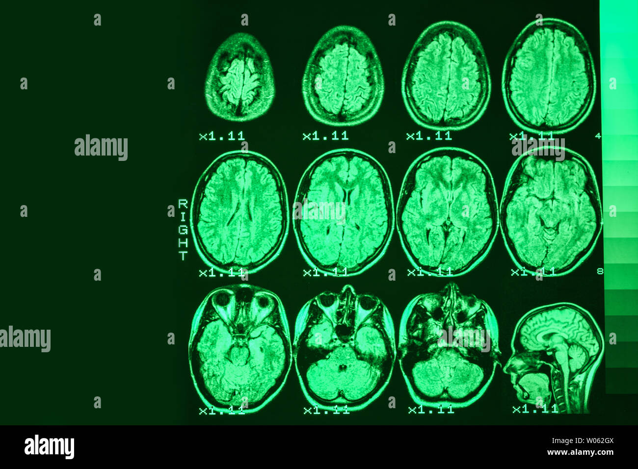 Mrt des Gehirns einer gesunden Person auf einem schwarzen Hintergrund mit grüner Hintergrundbeleuchtung. Links Platz für Werbung Beschriftung Stockfoto