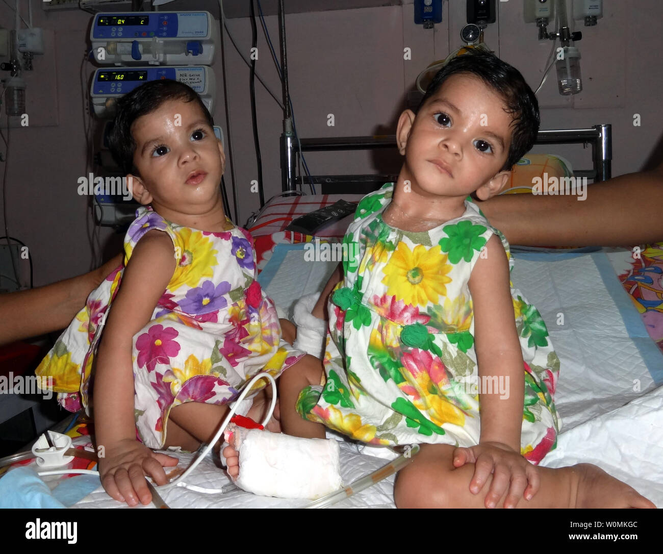 Früher siamesische Zwillinge, Stuti (L) und Aradhana sitzen nebeneinander im Missionskrankenhaus in Padhar, Cavelossim, zentrale Indien am 28. Juni 2012. Die 1-Jahr-olds wurden erfolgreich getrennt nach einer 12-stündigen Operation am 20. Juni, von einem Team von 34 medizinischen Experten durchgeführt, darunter 23 Ärzte, aus Indien und dem Ausland gezeichnet. Die 1-Jahr-alten Schwestern, die an Herz und Leber verbunden waren. UPI Foto/STR. Stockfoto