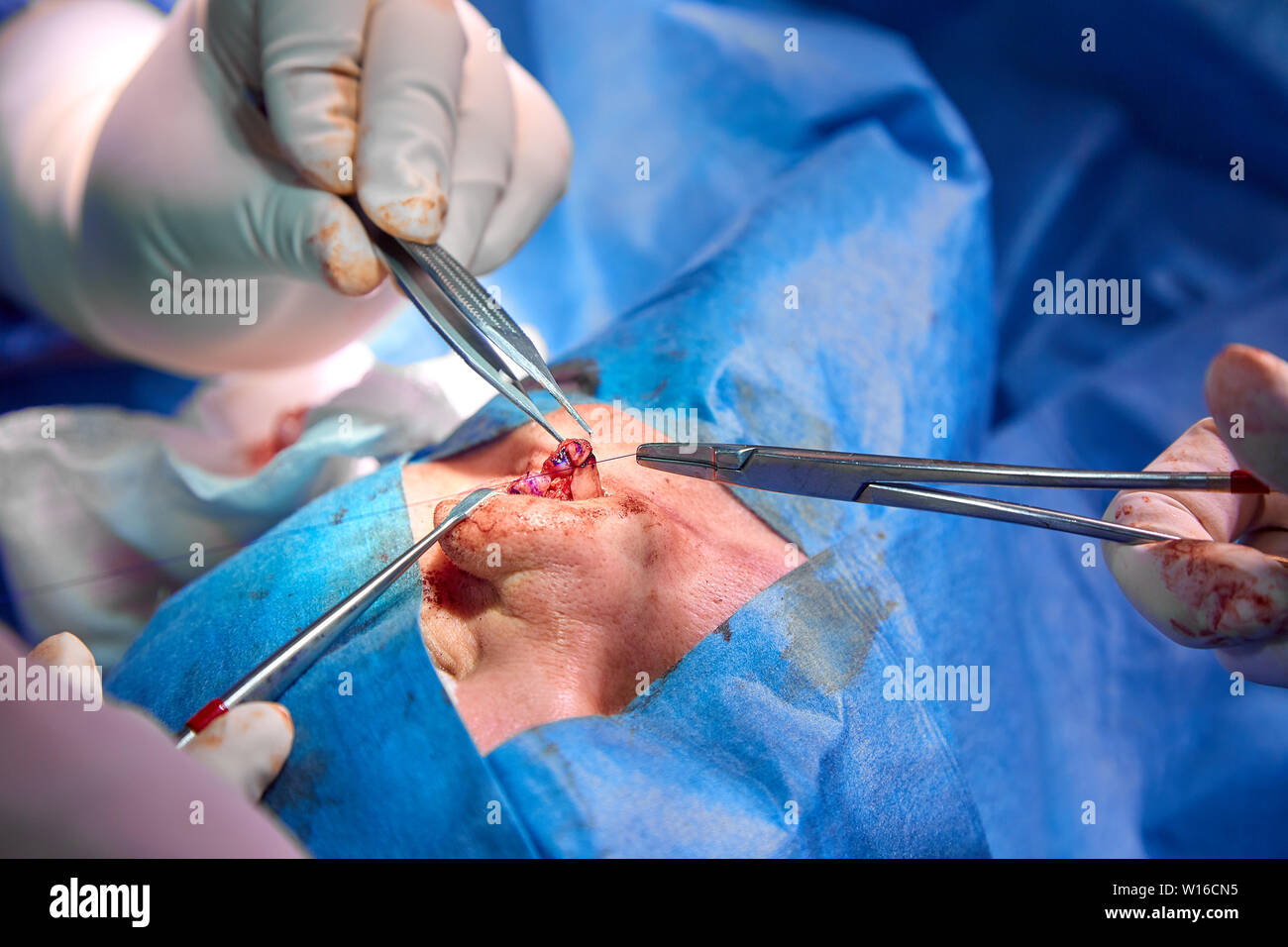 Chirurg und seine Assistentin, die kosmetische Chirurgie an der Nase im Krankenhaus Op. Nase Umgestalten, Augmentation. Rhinoplastik. Stockfoto