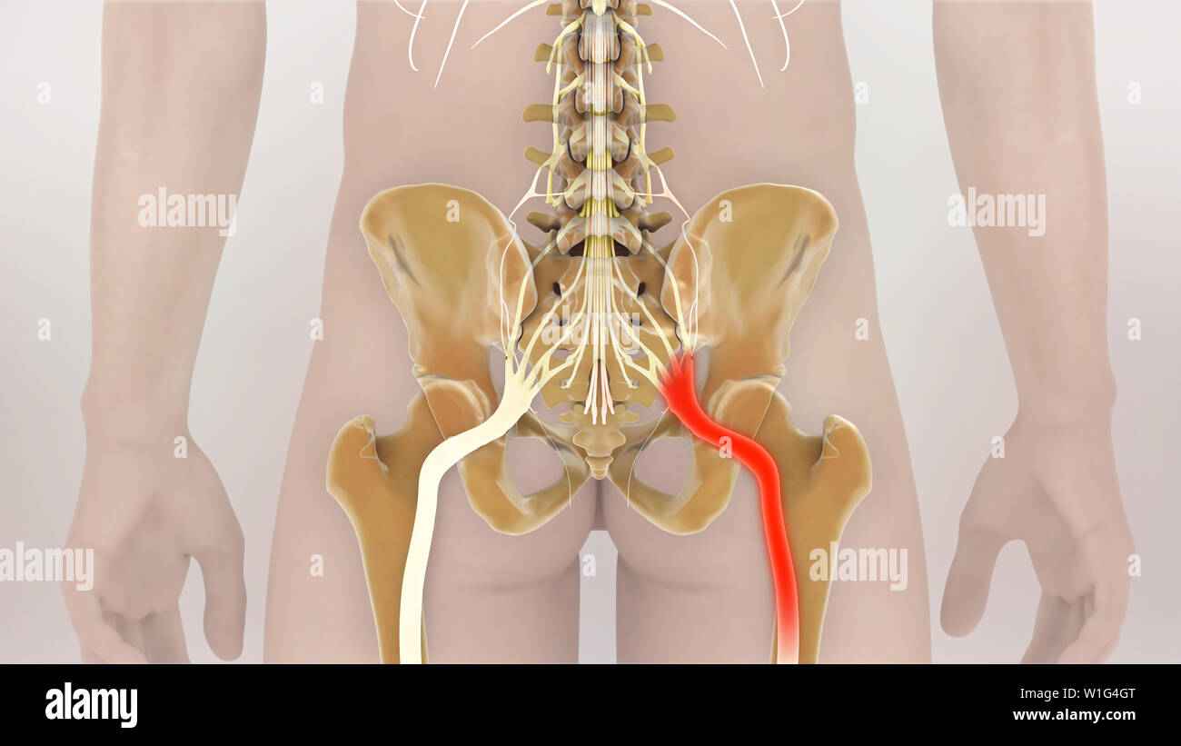 Ischias eingeklemmt Nervenschmerzen 3D-Darstellung Stockfoto