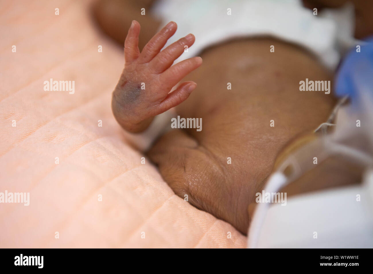 Frühgeborene babys Hand im Krankenhaus Stockfoto