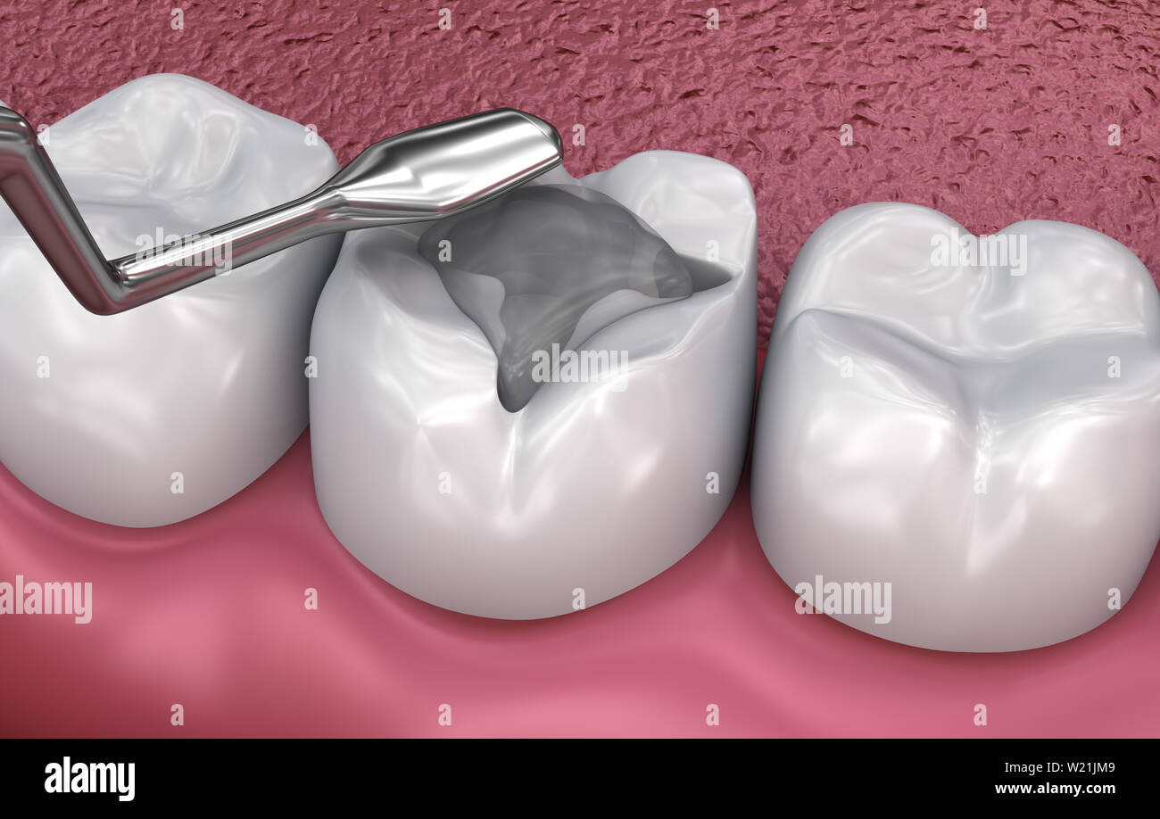 Zahnmedizinische Riss, Füllungen, Medizinisch genaue 3D-Darstellung Stockfoto