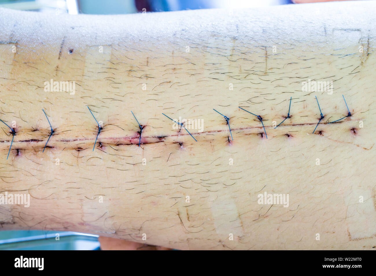 Narbe von der Bedienung naht mit einem blauen Faser am Bein des Patienten Stockfoto