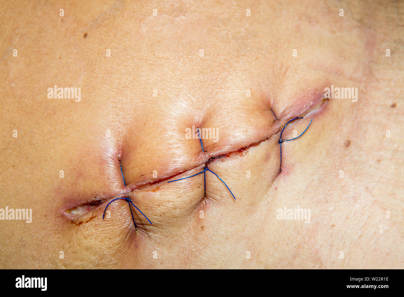 Narbe von der Bedienung naht mit einem blauen Faser am Bein des Patienten  Stockfotografie - Alamy