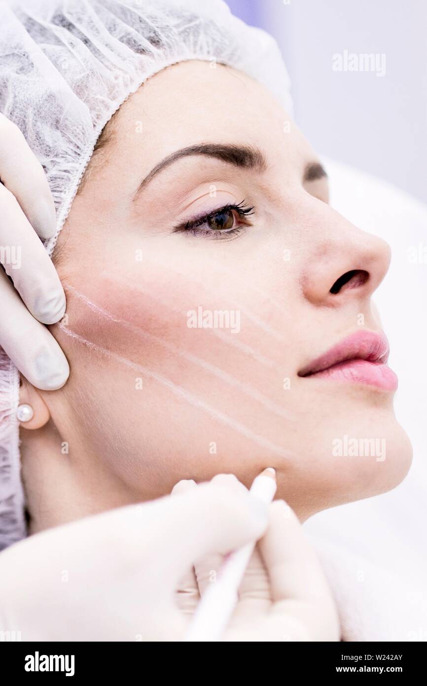 Dermatologe Zeichnung Markierungen auf Frau Gesicht für Thread-lift, close-up. Stockfoto