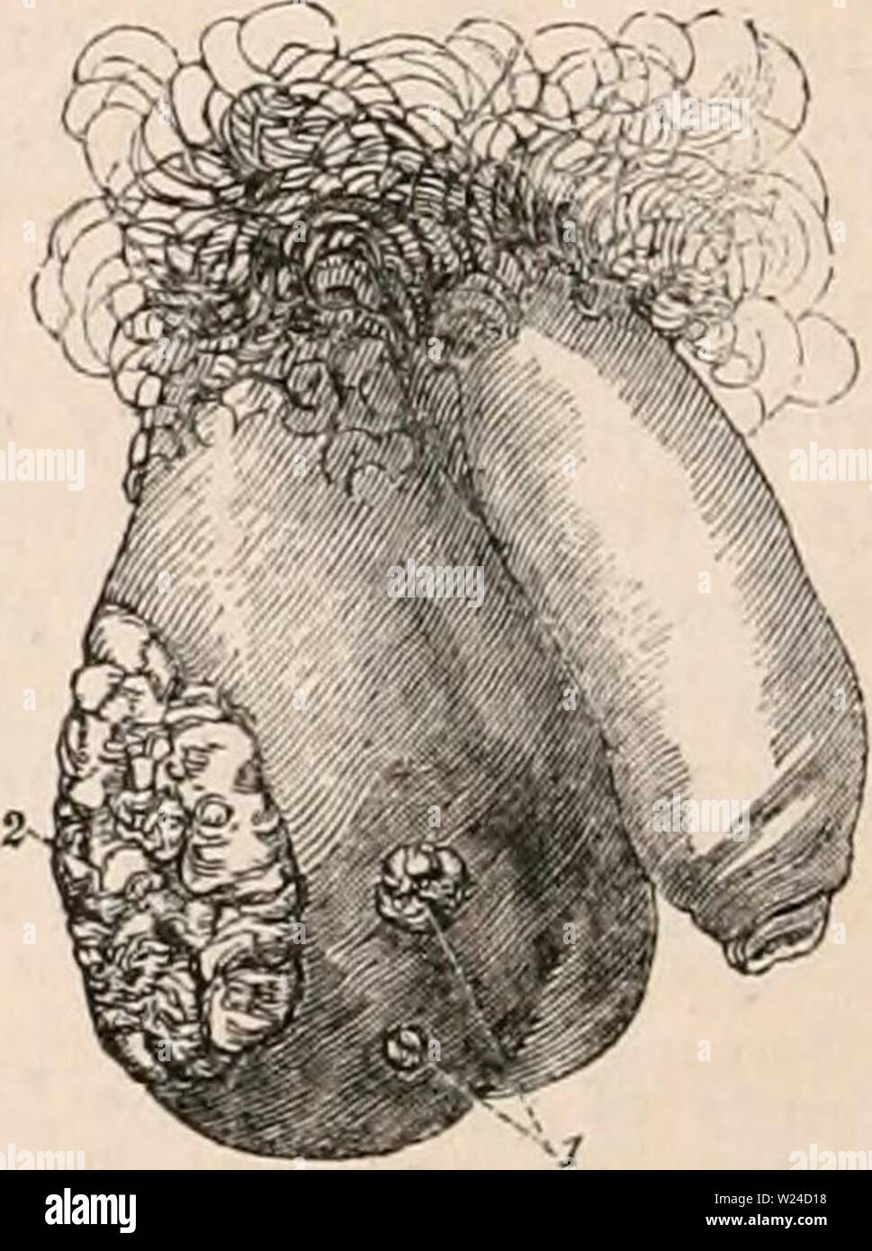 Archiv Bild von Seite 229 des cyclopaedia von Anatomie und. Die cyclopaedia von Anatomie und Physiologie cyclopdiaofana 0402 Todd Jahr: 1849 eines schwarzen Mannes, mit Elefantiasis, von Dr. Titley Arbeiten zum Thema "Krankheiten der Geschlechtsorgane berührt, die in der männlichen, "der Tumor de-scended fast zu den Knöcheln. Elefantiasis der Hodensack ist eine krankhafte Zuneigung der dermalen Hüllen, analog zu der Erweiterung der Extremitäten, die allgemein von den Namen der Barbadues Bein bekannt; mit der, in der Tat, in den Ländern, in denen die Krankheit überwiegend ist, haftet es an Com werden kombiniert. Elefantiasis der Hodensack, Stockfoto