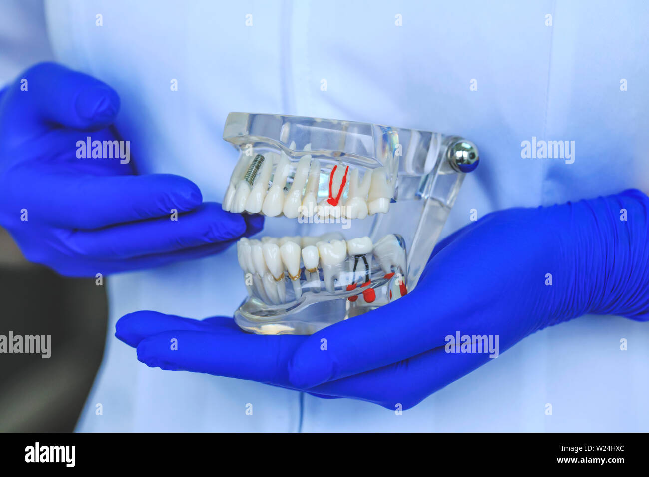 Echten Zahnschmuck Modell zeigt Zähne, Wurzeln, Zahnfleischbluten, Parodontose, Karies, metallischen Implantaten und Plaque. Zahnheilkunde Lernen der Schüler kieferorthopädische Ausrüstu Stockfoto