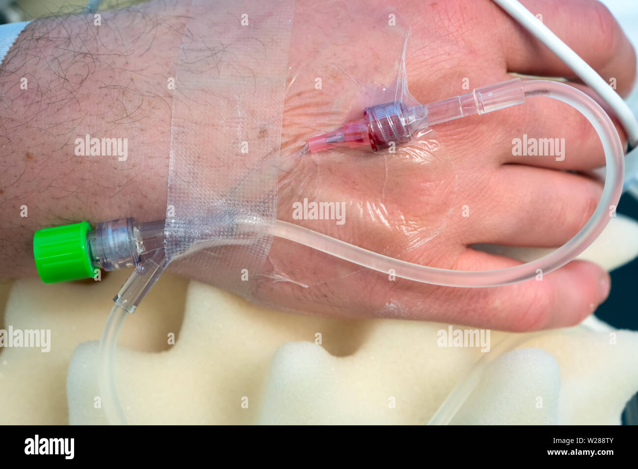 Eine Hand eines Patienten, die sich einer Operation mit einem kristalloide Infusionslösung goung durch einen 20 G IV, eine Schnur von einem Verwerfbaren pulse oxymeter Sonde läuft Acros Stockfoto