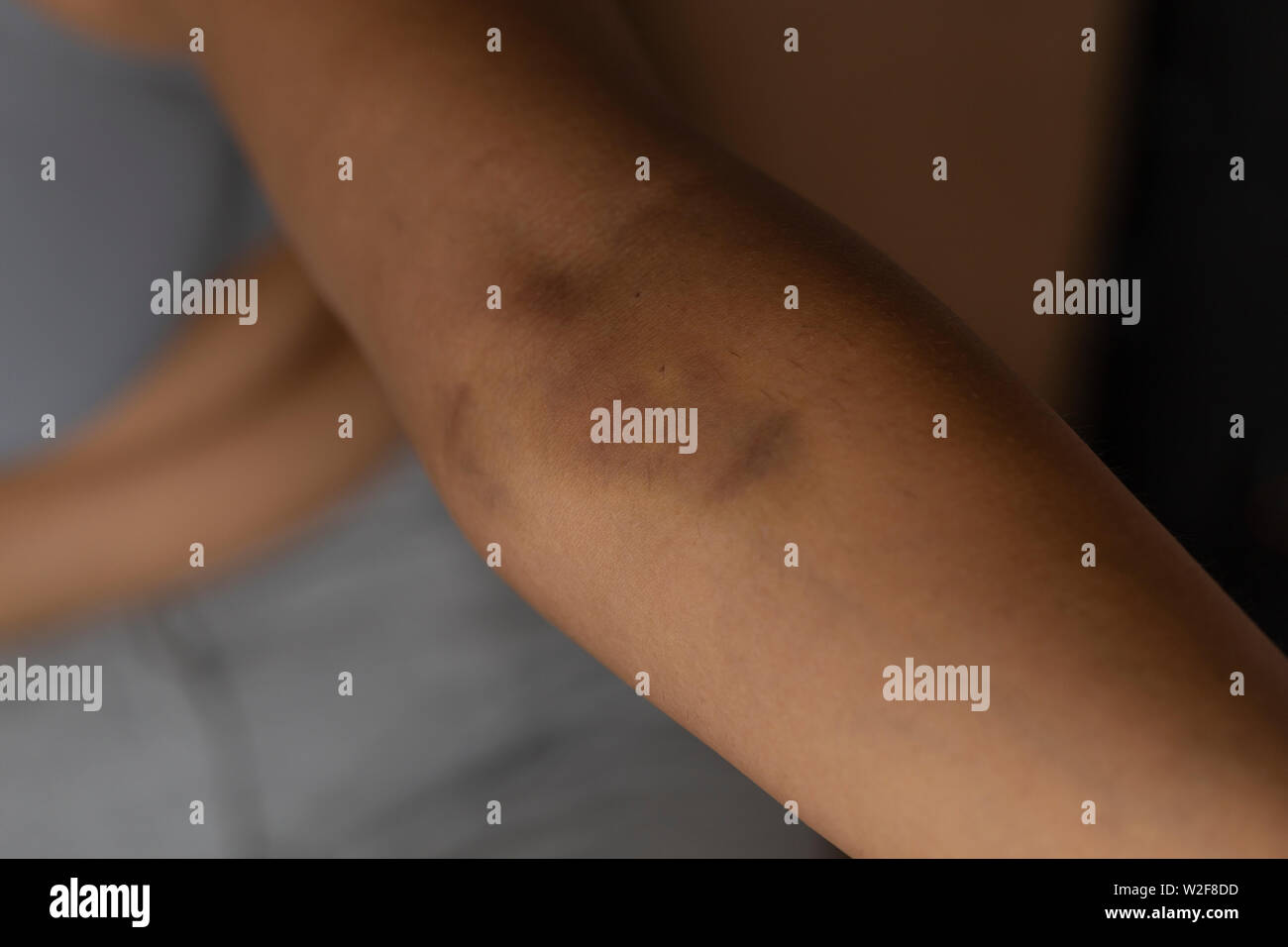 Blaue Flecken auf den Arm eines Frauen-Problem Haut auf dem Arm  Stockfotografie - Alamy