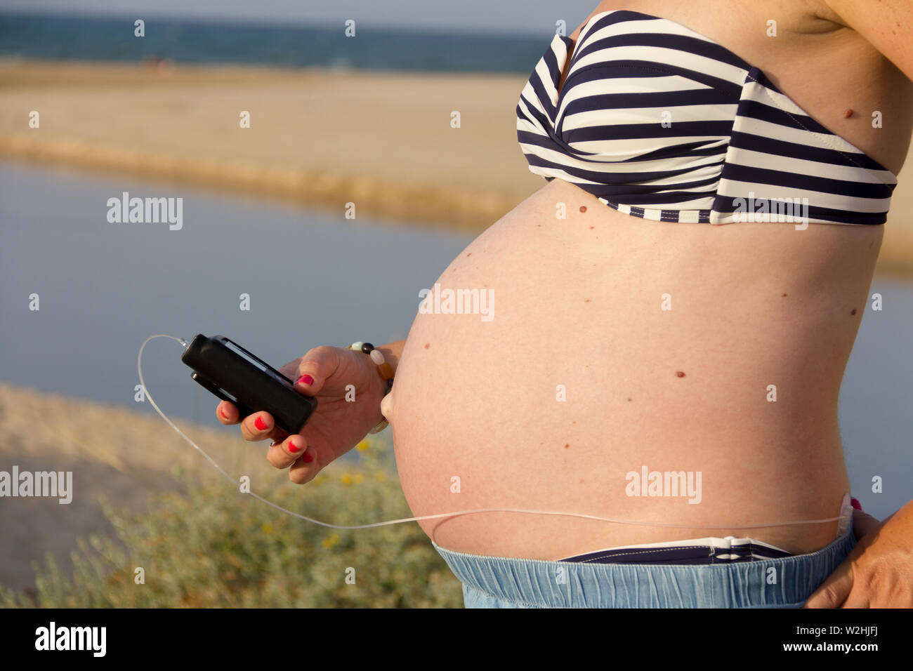 Eine diabetische schwangere Frau mit einer Insulinpumpe am Strand. Sie trägt einen blauen Rock und einem gestreiften Bikini Top. Stockfoto