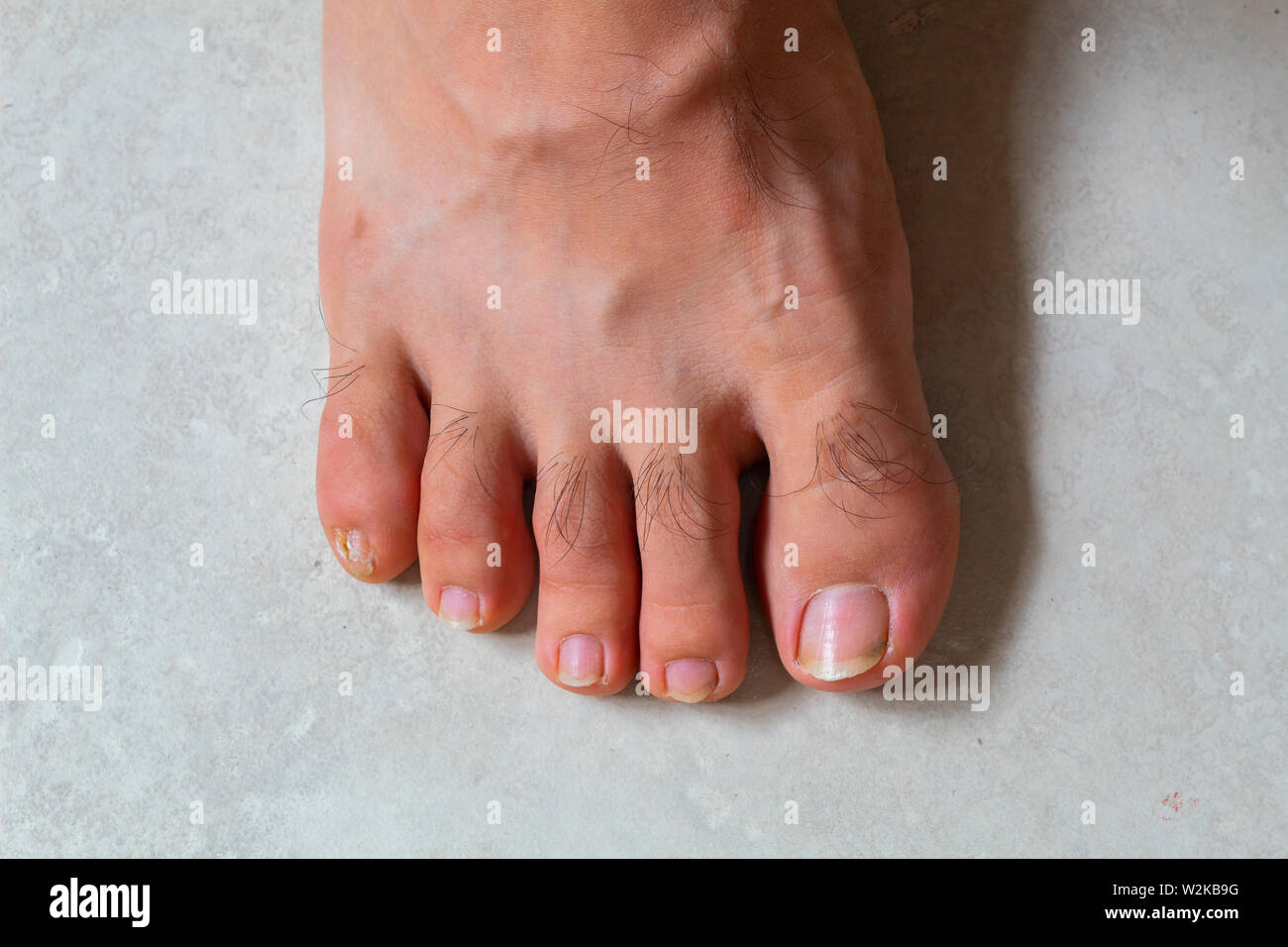 In der Nähe der Füße mit einer Wunde am kleinen Finger Stockfoto