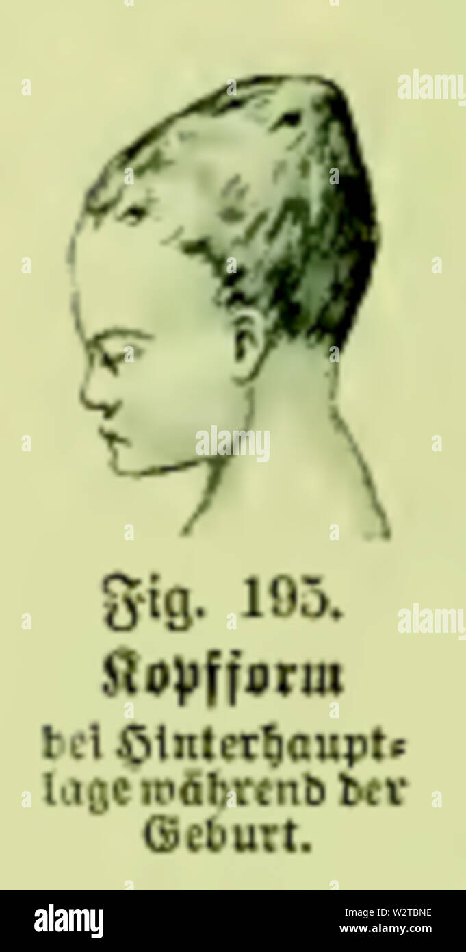 Die Frau als Hausärztin (1911) 195 Hinterhauptlage 5/6 Kopfform bei der Geburt Stockfoto