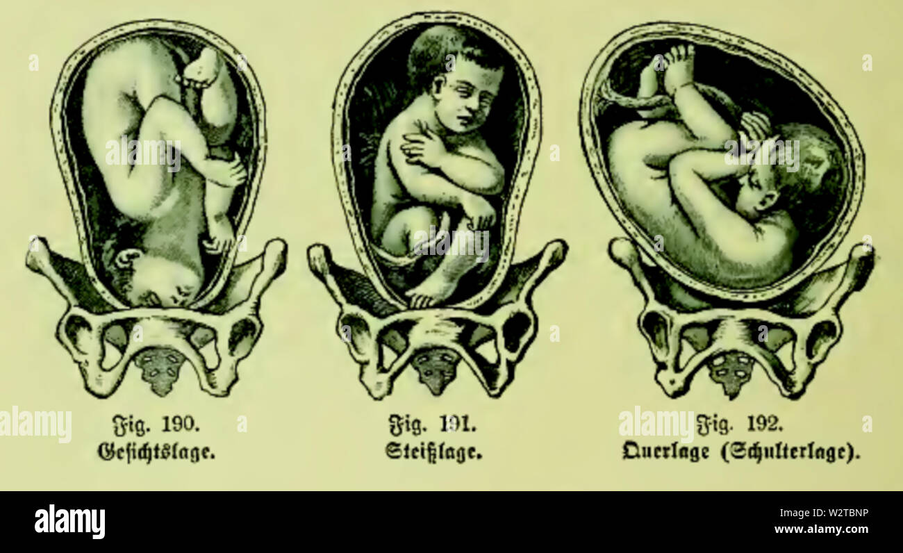 Die Frau als Hausärztin (1911) 190 192 Lagen des Kindes bei der Geburt Stockfoto