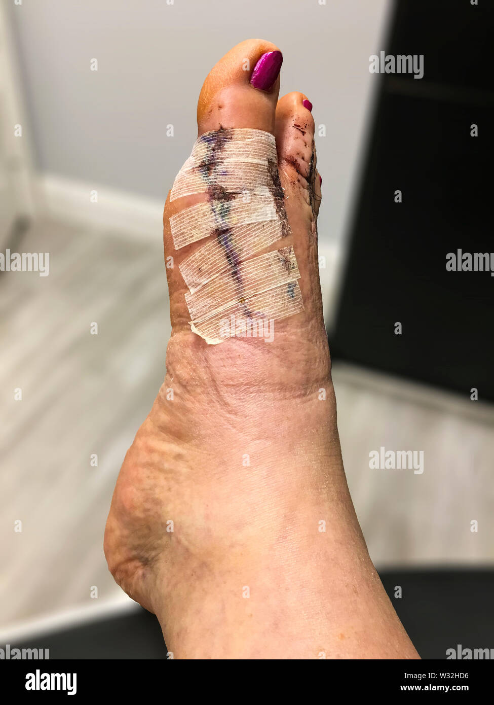 Tag 10 nach bunion und Hammertoe Chirurgie, recht, bevor die Fäden gezogen wurden. Stockfoto