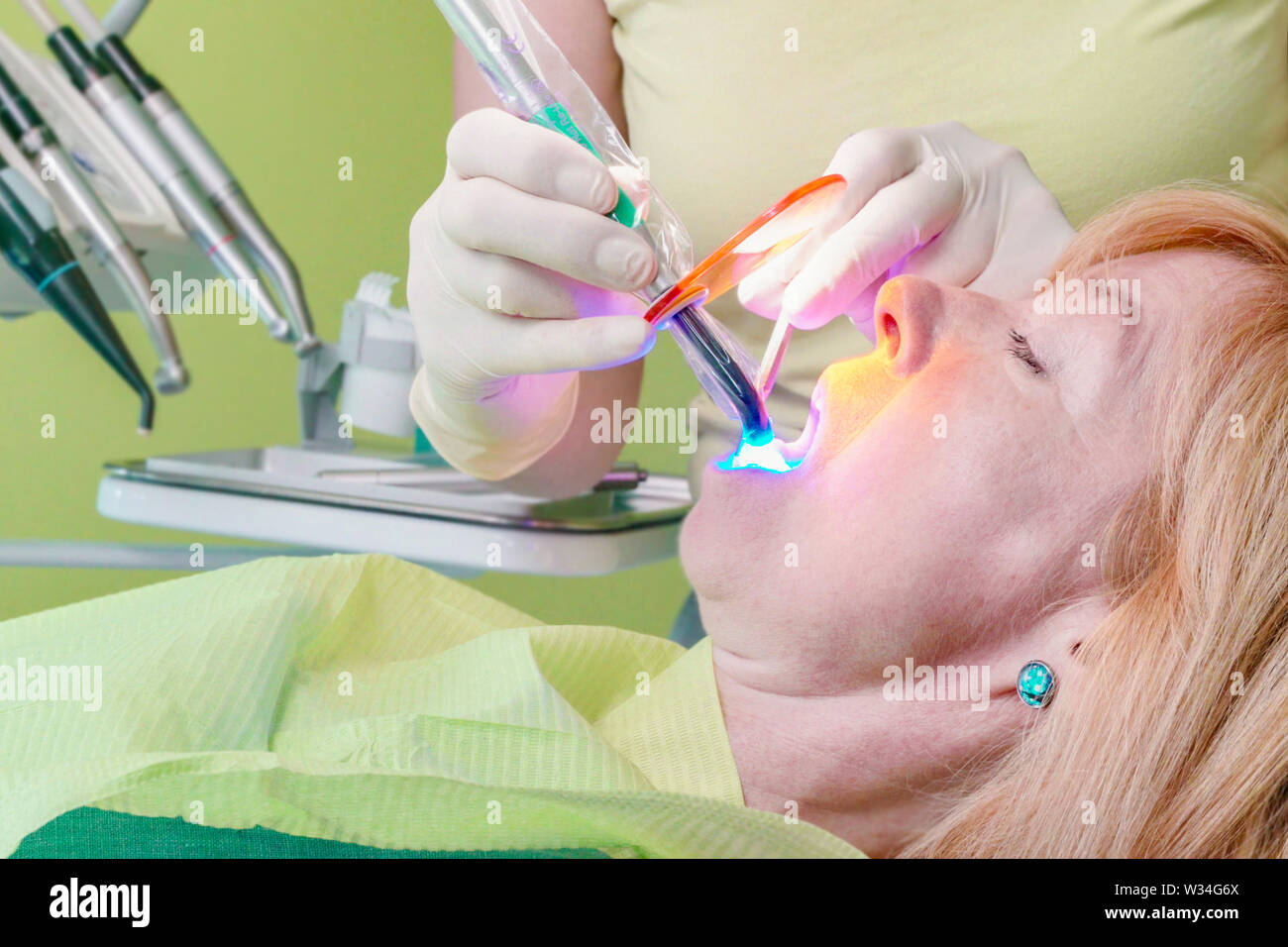 Ein in der Hand gehaltenes Wand strahlt, dass Primäre blaues Licht verwendet wird das Harz in eine zahnmedizinische Patienten öffnung zu kurieren. Stockfoto