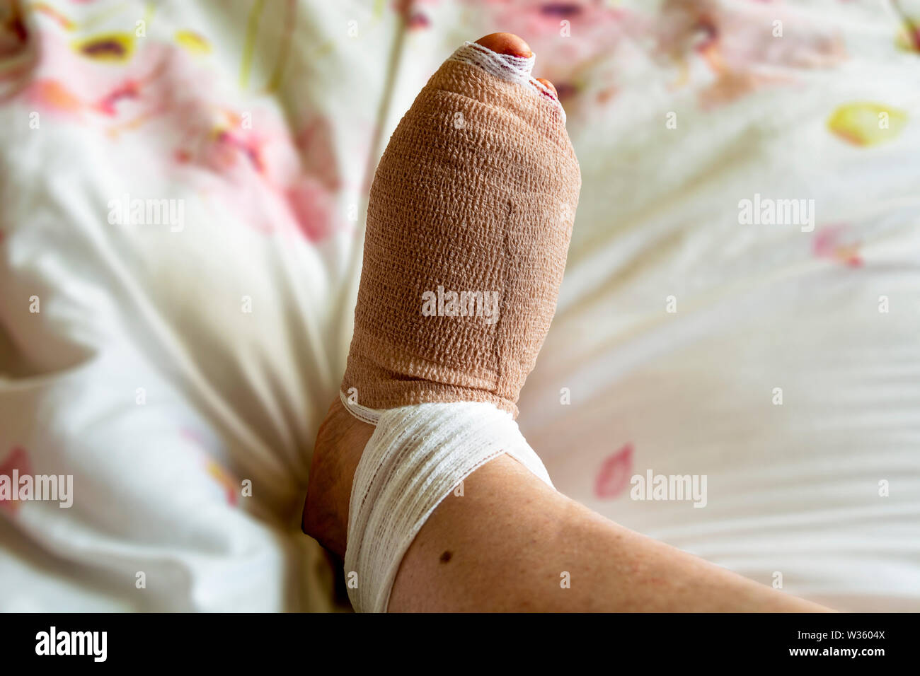 Bandagierten Fuß wenige Stunden nach bunion und Hammertoe Chirurgie auf dem rechten Fuß, eine Frau in den 60ern. Erster Tag der Fußchirurgie. Stockfoto