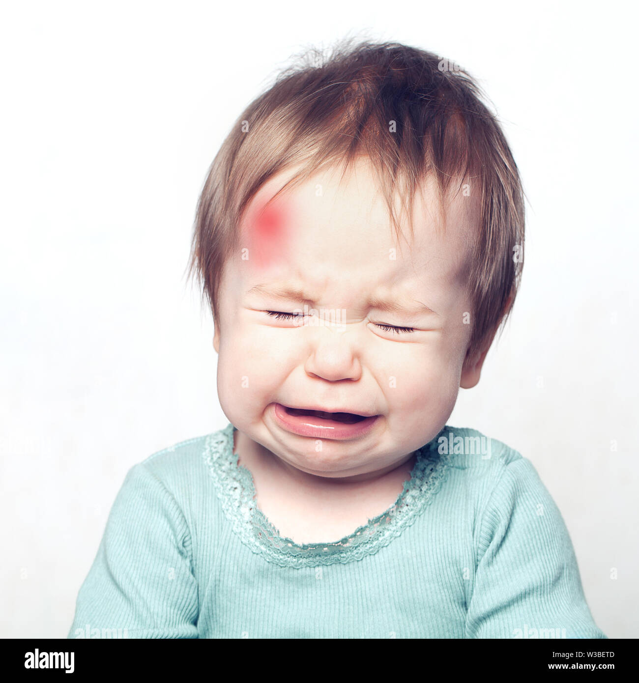 Kleines Baby mit prellung zu weinen. Medizinisches Konzept Stockfoto