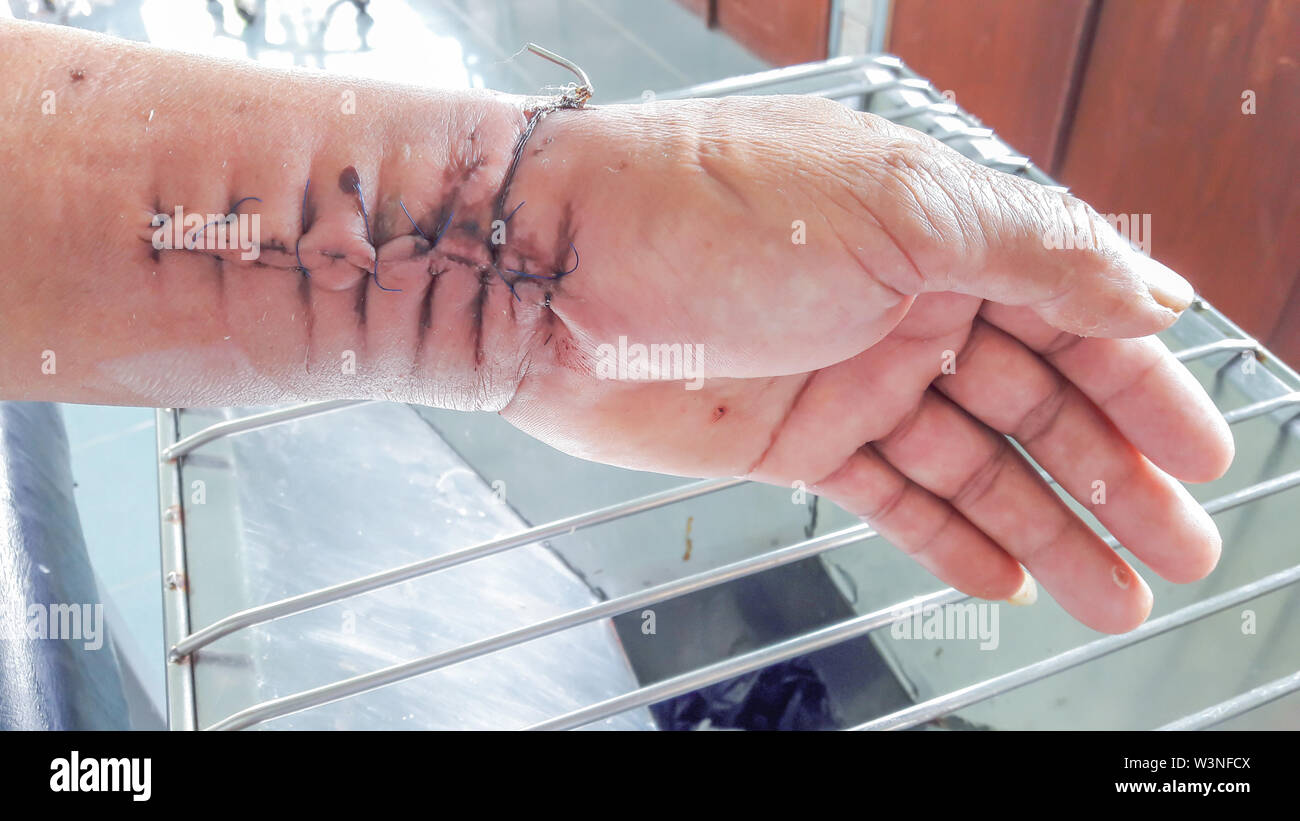 Narbe von der Bedienung naht mit einem blauen Faser am Arm des Patienten Stockfoto