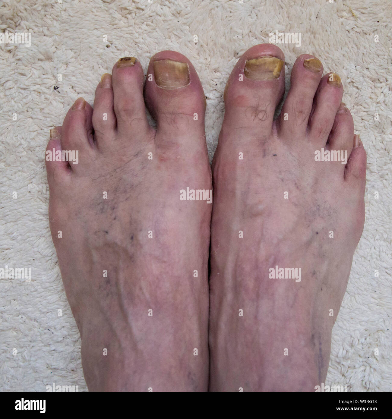 Onychomycosis mit Pilzen nagelinfektion zwei Füße Stockfotografie - Alamy